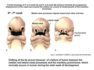 Frontal drawings of 4- to 5-week (A) and 5- to 6-week (B) embryos illustrate the progressive
displacement of the nasal sacs toward the midline as a result of medial growth of the maxillary
processes.
Som P , and Naidich T AJNR Am J Neuroradiol 2013;34:2233-2240
Clefting of the lip occurs because of a failure of fusion between the
median and lateral nasal processes and the maxillary prominence, which
normally occurs in human during the sixth week of development
Lateral nasal
Medial nasal
5th -7th week Medial nasal processes migrate toward each other and fuse
 