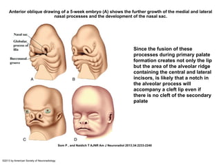 Anterior oblique drawing of a 5-week embryo (A) shows the further growth of the medial and lateral
nasal processes and the development of the nasal sac.
Som P , and Naidich T AJNR Am J Neuroradiol 2013;34:2233-2240
©2013 by American Society of Neuroradiology
Since the fusion of these
processes during primary palate
formation creates not only the lip
but the area of the alveolar ridge
containing the central and lateral
incisors, is likely that a notch in
the alveolar process will
accompany a cleft lip even if
there is no cleft of the secondary
palate
 