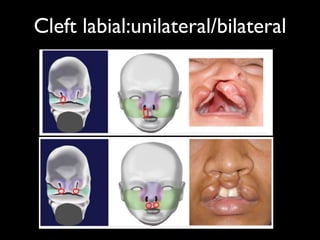 Cleft labial:unilateral/bilateral
 