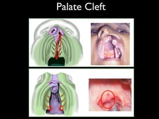 Palate Cleft
 