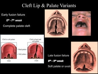 Late fusion failure
8th - 9th week
Soft palate or uvula
Cleft Lip & Palate Variants
Early fusion failure
6th -7th week
Complete palate cleft
 