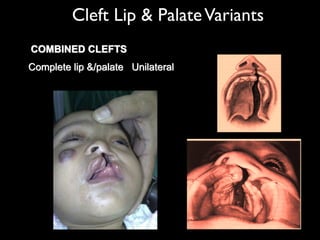 Cleft Lip & PalateVariants
COMBINED CLEFTS
Complete lip &/palate Unilateral
 