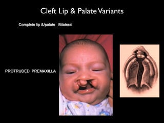 Cleft Lip & PalateVariants
Complete lip &/palate Bilateral
PROTRUDED PREMAXILLA
 