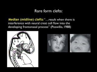 Rare form clefts:
Median (midline) clefts:“…result when there is
interference with neural crest cell ﬂow into the
developing frontonasal process” (Poswillo, 1988)
 