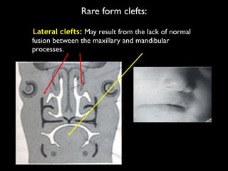 Rare form clefts:
Lateral clefts: May result from the lack of normal
fusion between the maxillary and mandibular
processes.
 