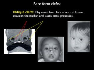 Rare form clefts:
Oblique clefts: May result from lack of normal fusion
between the median and lateral nasal processes.
 