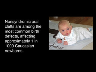 Nonsyndromic oral
clefts are among the
most common birth
defects, affecting
approximately 1 in
1000 Caucasian
newborns.
 