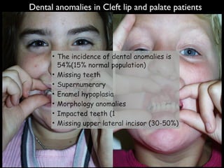 Dental anomalies in Cleft lip and palate patients
• The incidence of dental anomalies is
54%(15% normal population)
• Missing teeth
• Supernumerary
• Enamel hypoplasia
• Morphology anomalies
• Impacted teeth (1
• Missing upper lateral incisor (30-50%)
Dental anomalies in Cleft lip and palate patients
 