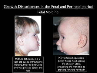 Fetal Molding
Midface deﬁciency in a 3-
year-old due to intrauterine
molding. Prior to birth, one
arm was pressed across the
face
Pierre Robin Sequence: a
tightly ﬂexed head against
the chest in utero,
preventing the mandible to
growing forward normally
Growth Disturbances in the Fetal and Perinatal period
 
