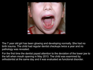 The 7 year old girl has been glowing and developing normally. She had no
birth trauma. The child had regular dentist checkups twice a year and no
pathology was revealed.
For the first time the dentist payed attention to the deviation of the lower jaw to
the left when mouth opening in May 2013. The child was examined by
orthodontist at the same day and it was evaluated as functional disorder.
!
!
 