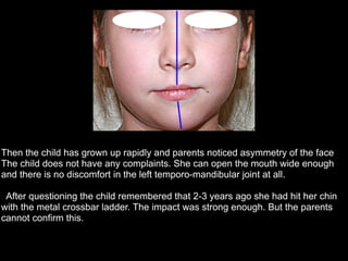 Then the child has grown up rapidly and parents noticed asymmetry of the face
The child does not have any complaints. She can open the mouth wide enough
and there is no discomfort in the left temporo-mandibular joint at all.
!
After questioning the child remembered that 2-3 years ago she had hit her chin
with the metal crossbar ladder. The impact was strong enough. But the parents
cannot confirm this.
 