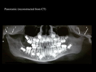 Panoramic (reconstructed from CT)
 