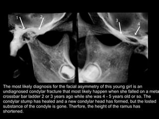The most likely diagnosis for the facial asymmetry of this young girl is an
undiagnosed condylar fracture that most likely happen when she falled on a meta
crossbar bar ladder 2 or 3 years ago while she was 4 - 5 years old or so. The
condylar stump has healed and a new condylar head has formed, but the losted
substance of the condyle is gone. Therfore, the height of the ramus has
shortened.
 