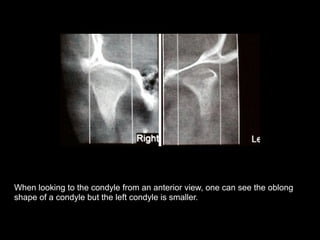 When looking to the condyle from an anterior view, one can see the oblong
shape of a condyle but the left condyle is smaller.
!
 