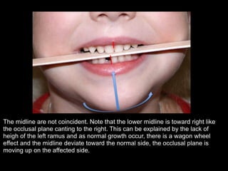The midline are not coincident. Note that the lower midline is toward right like
the occlusal plane canting to the right. This can be explained by the lack of
heigh of the left ramus and as normal growth occur, there is a wagon wheel
effect and the midline deviate toward the normal side, the occlusal plane is
moving up on the affected side.
!
!
 