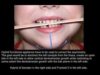 Hybrid functional appliance have to be used to correct the asymmetry.
The goal would be to disctract the left condyle from the fossa, create an open
bite in the left side to allow vertical dentoalveolar growth while restricting to
some extent the dentoalveolar growth with the bite plane in the left side.
!
Hybrid of bionator in the right side and Frankell II in the left side.
!
	

 