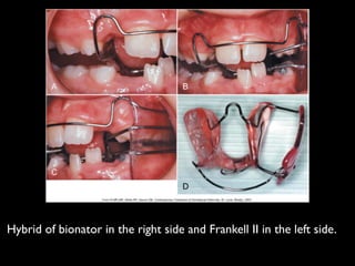 !
!
Hybrid of bionator in the right side and Frankell II in the left side.	

!
	

 