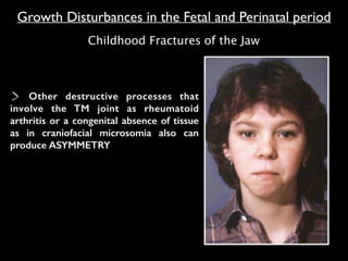 Other destructive processes that
involve the TM joint as rheumatoid
arthritis or a congenital absence of tissue
as in craniofacial microsomia also can
produce ASYMMETRY
Growth Disturbances in the Fetal and Perinatal period
Childhood Fractures of the Jaw
 