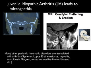 Juvenile Idiopathic Arthritis (JIA) leads to
micrognathia 	

Many other pediatric rheumatic disorders are associated
with arthritis (Systemic Lupus Erythematosus, myositis,
sarcoidosis, Sjogren, mixed connective tissue disease,
etc.)
 