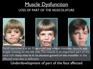 Muscle Dysfunction
Idiopathic, birth injury, damage to the motor nerve
Underdevelopment of part of the face affected
LOSS OF PART OF THE MUSCOLATURE
Facial asymmetry in an 11-year-old boy whose masseter muscle was
largely missing on the left side.The muscle is an important part of the
total soft tissue matrix; in its absence growth of the mandible in the
affected area also is deﬁcient.
 