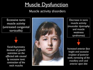 Eccessive tonic
muscle activity	

(untreated congenital
torticollis)
Decrease in tonic
muscle activity 	

(muscolar dystrophy
and muscle
weakness
syndromes)
Facial Asymmetry
because of growth
restriction on the
affected side caused
by excessive tonic
contraction of the
neck muscles
Increased anterior face
height and excessive
eruption of posterior
teeth, narrowing of the
maxillary arch and
anterior open bite
Muscle Dysfunction
Muscle activity disorders
 