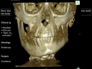 Hemimandibular Hypertrophy
Histology
!
Proliferation of the condylar cartilage
Rare disease that results from unilateral excessive growth of the mandible, involves both
the body and ramus of mandible and leads to facial asymmetry
Clinical signs
!
• Mandible deviation to the opposite side	

• Chin protrusion	

• Open bite on the affected side and cross bite in the
controlateral side
Surgery
!
Condilectomy of the affected side
 