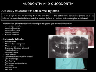 ANODONTIA AND OLIGODONTIA
Manifestazioni cliniche
	

 •	

 Abnormal nails	

	

 •	

 Abnormal or missing teeth	

	

 •	

 Absent or decreased tears	

	

 •	

 Decreased skin color (pigment)	

	

 •	

 Heat intolerance	

	

 •	

 Inability to sweat	

	

 •	

 Large forehead	

	

 •	

 Lower than normal number of teeth	

	

 •	

 Low nasal bridge	

	

 •	

 Poor hearing	

	

 •	

 Poor temperature regulation	

	

 •	

 Poor vision	

	

 •	

 Thin, sparse hair	

	

 •	

 Thin skin	

Group of syndromes all deriving from abnormalities of the ectodermal structures (more than 150
different types), inherited disorders that involve defects in the hair, nails, sweat glands and teeth
The inheritance patterns are variable according to the speciﬁc type of ED. Patterns include:	

	

 •	

 spontaneous mutations	

	

 •	

 autosomal dominant	

	

 •	

 autosomal recessive	

	

 •	

 X-linked dominant	

	

 •	

 X-linked recessive	

Are usually associated with Ectodermal Dysplasia
 