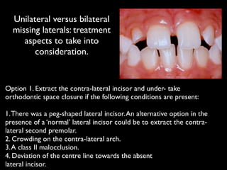 Unilateral versus bilateral
missing laterals: treatment
aspects to take into
consideration.
Option 1. Extract the contra-lateral incisor and under- take
orthodontic space closure if the following conditions are present:	

!
1.There was a peg-shaped lateral incisor.An alternative option in the
presence of a ‘normal’ lateral incisor could be to extract the contra-
lateral second premolar.	

2. Crowding on the contra-lateral arch.	

3.A class II malocclusion.	

4. Deviation of the centre line towards the absent	

lateral incisor.
 