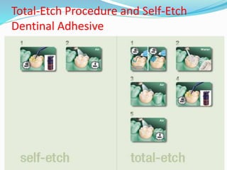 Total-Etch Procedure and Self-Etch
Dentinal Adhesive
 