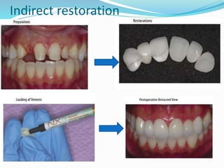 Indirect restoration
 