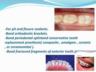 -For pit and fissure sealants.
-Bond orthodontic brackets.
-Bond periodontal splintand conservative tooth
replacement prosthesis( composite , amalgam , ceramic
, or ceramometal ).
-Bond fractured fragments of anterior teeth.
 