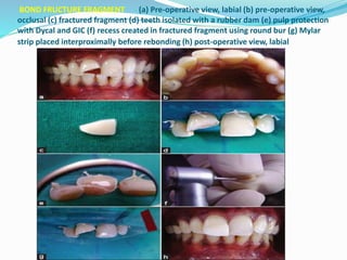 BOND FRUCTURE FRAGMENT (a) Pre-operative view, labial (b) pre-operative view,
occlusal (c) fractured fragment (d) teeth isolated with a rubber dam (e) pulp protection
with Dycal and GIC (f) recess created in fractured fragment using round bur (g) Mylar
strip placed interproximally before rebonding (h) post-operative view, labial
 