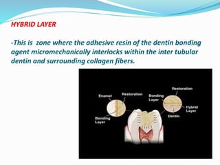 HYBRID LAYER
-This is zone where the adhesive resin of the dentin bonding
agent micromechanically interlocks within the inter tubular
dentin and surrounding collagen fibers.
 