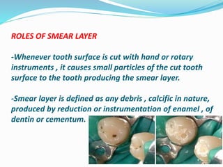 ROLES OF SMEAR LAYER
-Whenever tooth surface is cut with hand or rotary
instruments , it causes small particles of the cut tooth
surface to the tooth producing the smear layer.
-Smear layer is defined as any debris , calcific in nature,
produced by reduction or instrumentation of enamel , of
dentin or cementum.
 
