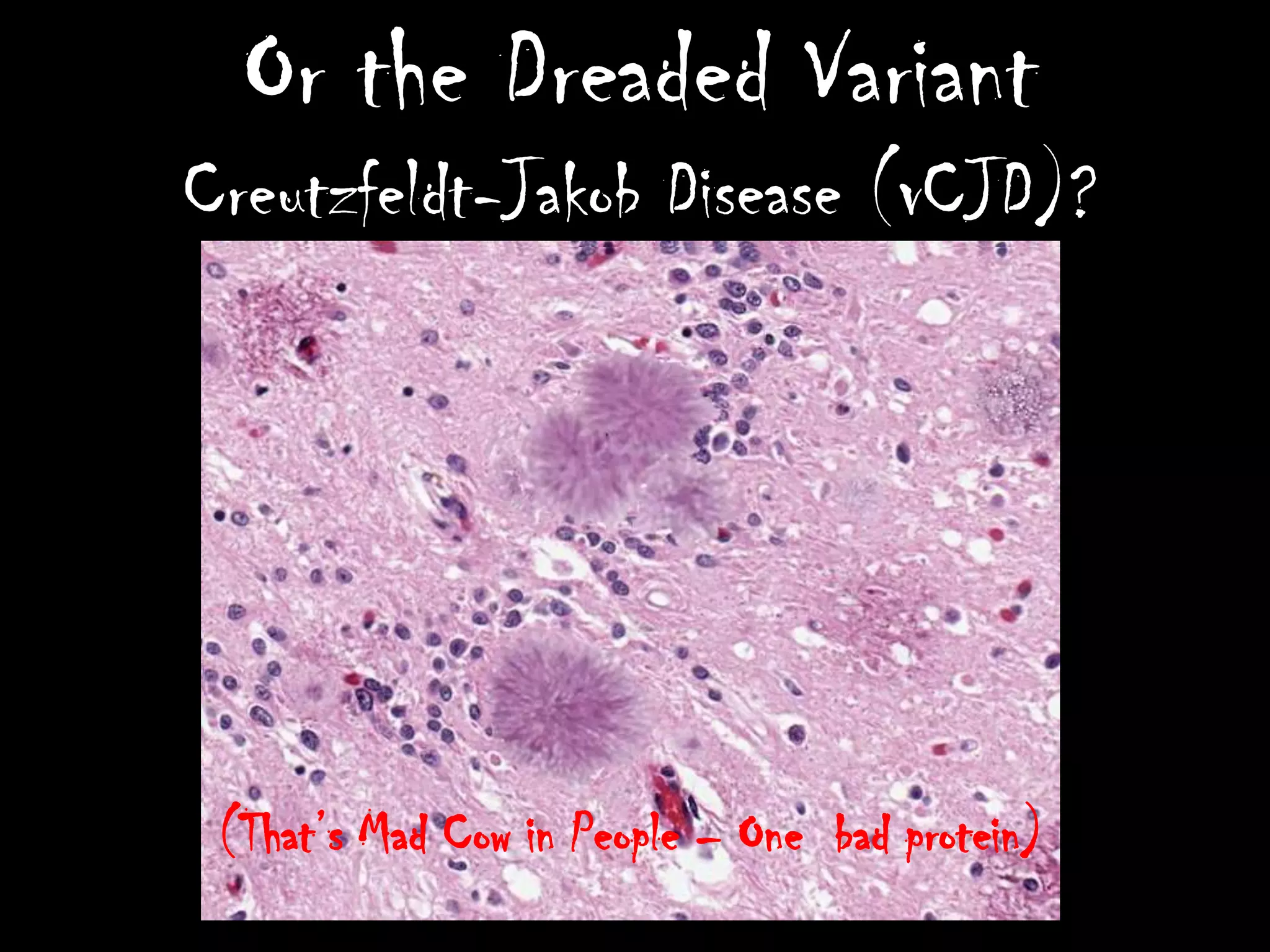 Or the Dreaded Variant
Creutzfeldt-Jakob Disease (vCJD)?




 (That’s Mad Cow in People – One bad protein)
 
