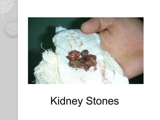 Kidney Stones
 