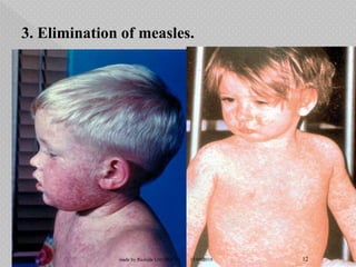 3. Elimination of measles.
15/08/2018 12made by Rashida GM (PGCN)
 