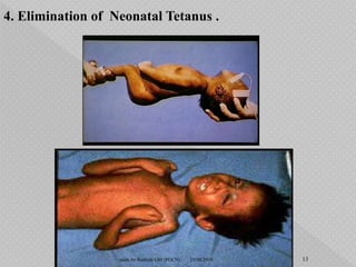 4. Elimination of Neonatal Tetanus .
15/08/2018 13made by Rashida GM (PGCN)
 
