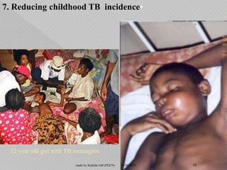 •7. Reducing childhood TB incidence
12 year old girl with TB meningitis
15/08/2018 16made by Rashida GM (PGCN)
 