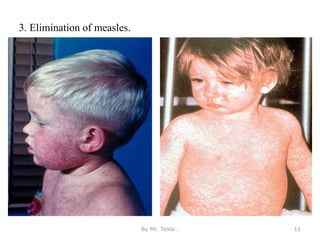 3. Elimination of measles.
By Mr. Teklu . 11
 