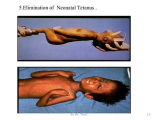 5.Elimination of Neonatal Tetanus .
By Mr. Teklu . 13
 