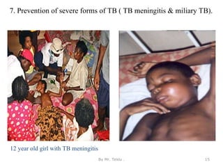 7. Prevention of severe forms of TB ( TB meningitis & miliary TB).
12 year old girl with TB meningitis
By Mr. Teklu . 15
 