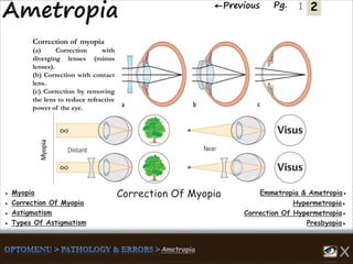 2←Previous Pg. 1
Correction of myopia
(a) Correction with
diverging lenses (minus
lenses).
(b) Correction with contact
lens.
(c) Correction by removing
the lens to reduce refractive
power of the eye.
Emmetropia & Ametropia●● Myopia
Hypermetropia●● Correction Of Myopia
Correction Of Hypermetropia●● Astigmatism
Presbyopia●● Types Of Astigmatism
Correction Of Myopia
 