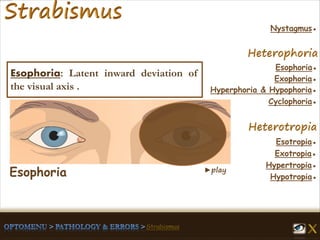 ►play
Esophoria●
Esotropia●
Hypertropia●
Exotropia●
Hypotropia●
Exophoria●
Hyperphoria & Hypophoria●
Cyclophoria●
Nystagmus●
Esophoria: Latent inward deviation of
the visual axis .
Esophoria
 