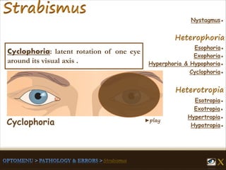 ►play
Esophoria●
Esotropia●
Hypertropia●
Exotropia●
Hypotropia●
Exophoria●
Hyperphoria & Hypophoria●
Cyclophoria●
Nystagmus●
Cyclophoria: latent rotation of one eye
around its visual axis .
Cyclophoria
 