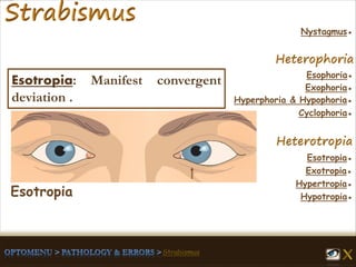Esophoria●
Esotropia●
Hypertropia●
Exotropia●
Hypotropia●
Exophoria●
Hyperphoria & Hypophoria●
Cyclophoria●
Nystagmus●
Esotropia: Manifest convergent
deviation .
Esotropia
 