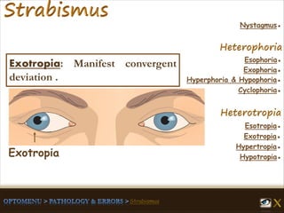 Esophoria●
Esotropia●
Hypertropia●
Exotropia●
Hypotropia●
Exophoria●
Hyperphoria & Hypophoria●
Cyclophoria●
Nystagmus●
Exotropia: Manifest convergent
deviation .
Exotropia
 