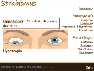 Esophoria●
Esotropia●
Hypertropia●
Exotropia●
Hypotropia●
Exophoria●
Hyperphoria & Hypophoria●
Cyclophoria●
Nystagmus●
Hypotropia: Manifest depressed
deviation .
Hypotropia
 