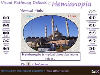 1Pg. 2 Scotoma→
Normal Field
Total Homonymous
Hemianopia
Partial Homonymous
Hemianopia
Homonymous
Quadrantopsia
Crossed
Quadrantopsia
Binasal
Hemianopia
Bitemporal
Hemianopia
Altitudinal
Hemianopia
Double
Hemianopia
Macular
Spared
Macular
Split
Normal Field
Hemianopia is typical binocular sector
defect .
L.E field R.E field
 