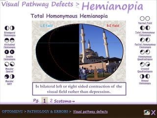 1Pg. 2 Scotoma→
Normal Field
Total Homonymous
Hemianopia
Partial Homonymous
Hemianopia
Homonymous
Quadrantopsia
Crossed
Quadrantopsia
Binasal
Hemianopia
Bitemporal
Hemianopia
Altitudinal
Hemianopia
Double
Hemianopia
Macular
Spared
Macular
Split
Total Homonymous Hemianopia
L.E field R.E field
Is bilateral left or right sided contraction of the
visual field rather than depression.
 